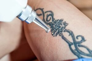 Détatouage au laser au centre Magenta à Nice